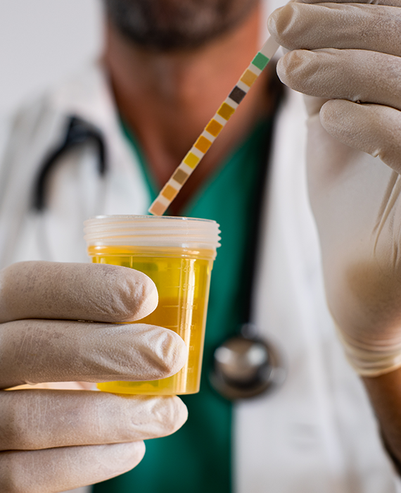 Image of a urine sample with a test strip, held by a doctor