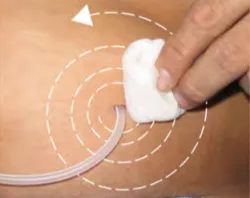 Exit site cleaning technique