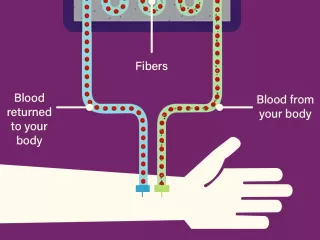 diagram illustrating the HD process where blood from your body is put through fibers to filter it and then returned to your body