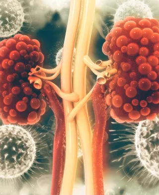 Illustration of kidneys covered in cysts.