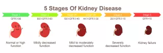 Five kidneys in various stages of chronic kidney disease. As kidney disease progresses from Stage 1 to Stage 5, the kidneys lose function and get smaller. 