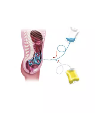 peritoneal dialysis