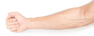 Healthy arm with good vascular access